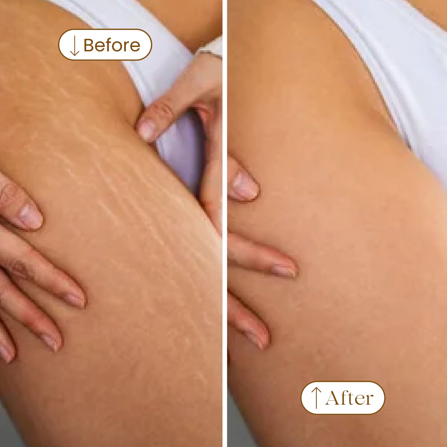 Ayurvedic Stretch Mark Oil
