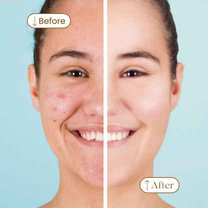 Oil Control Face Wash - For Acne & Oily Skin